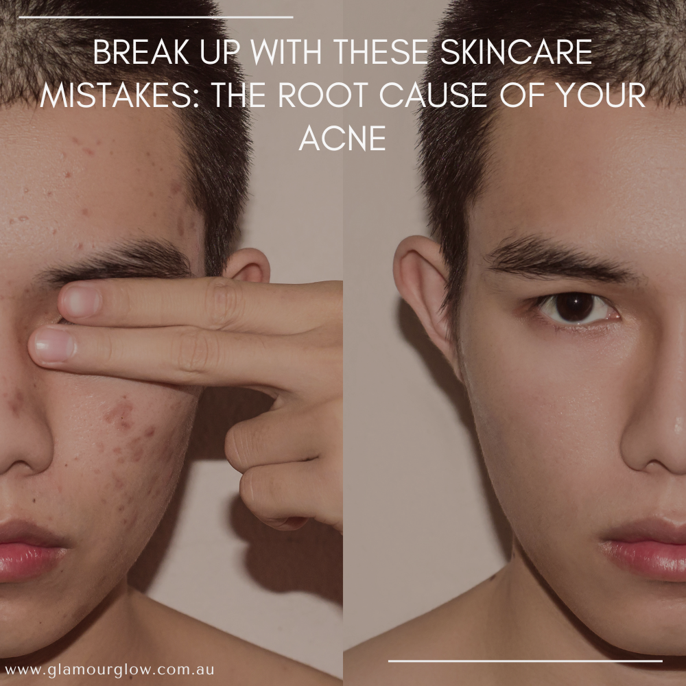 Break Up with These Skincare Mistakes: The Root Cause of Your Acne