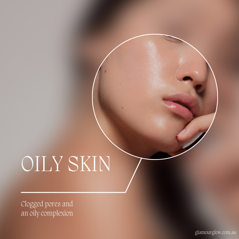 Oily Skin: Managing Excess Oil Production