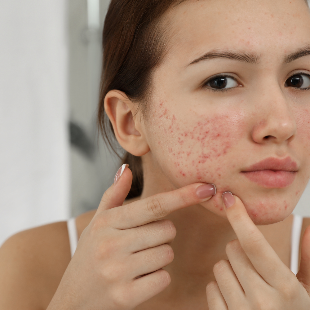 Acne Prone Skin